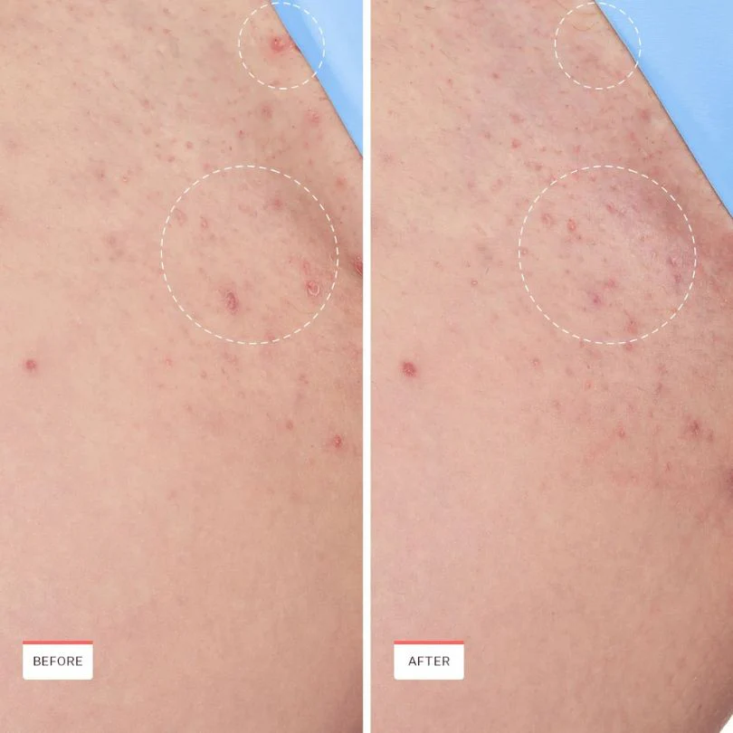 Smoothing Solution Ingrown Hair Treatment - Image 7